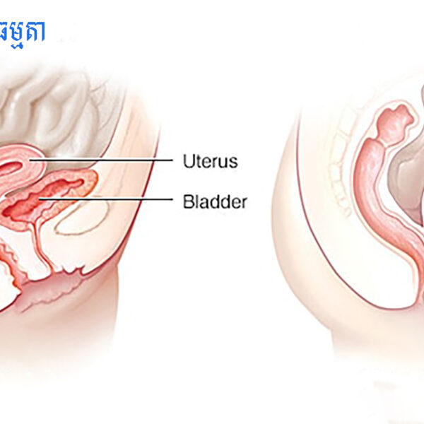 ស្វែងយល់ពីជំងឺស្រុតស្បូននិងវិធីព្យាបាល!