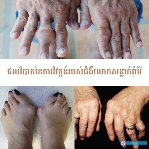ការស្វែងយល់ពីជំងឺរលាកសន្លាក់រ៉ាំរ៉ៃ