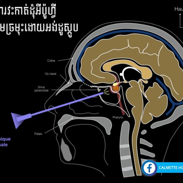 មន្ទីរពេទ្យកាម៉ែត៖ មើលមិនសូវច្បាស់អាចបណ្តាលមកពីបញ្ហាដុំសាច់ក្នុងខួរក្បាល