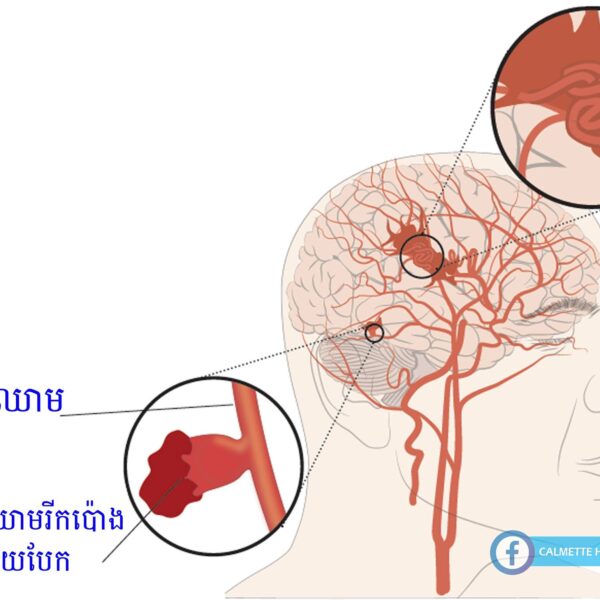 ស្វែងយល់ពីមូលហេតុ និងរោគសញ្ញានៃការហូរឈាមនៅក្នុងស្រោមខួរក្បាល